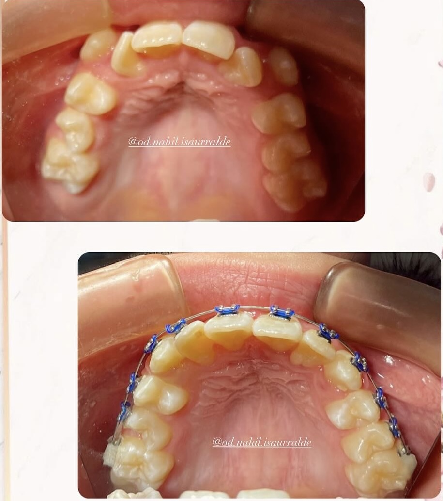 Detalle de brackets cerámicos estéticos de alta precisión en Paraná